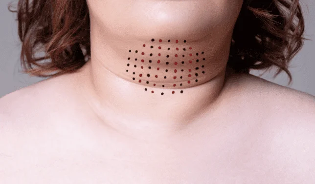 Belkyra Double Chin 1