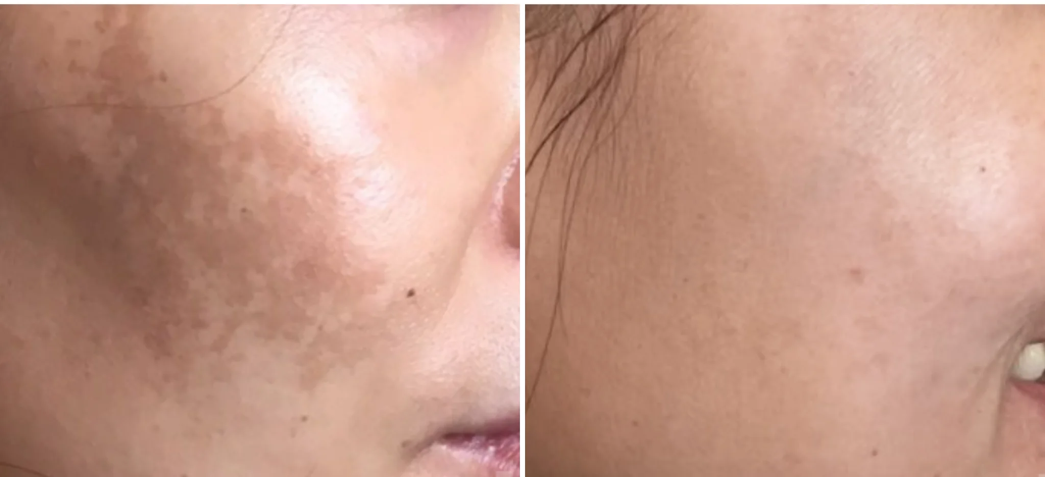 Microneedling Vancouver 7 Untitled-design-28-2.webp