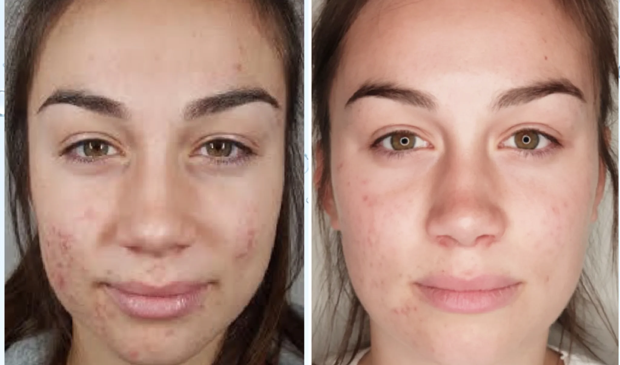 Microneedling Vancouver 8 Untitled-design-29-2.webp