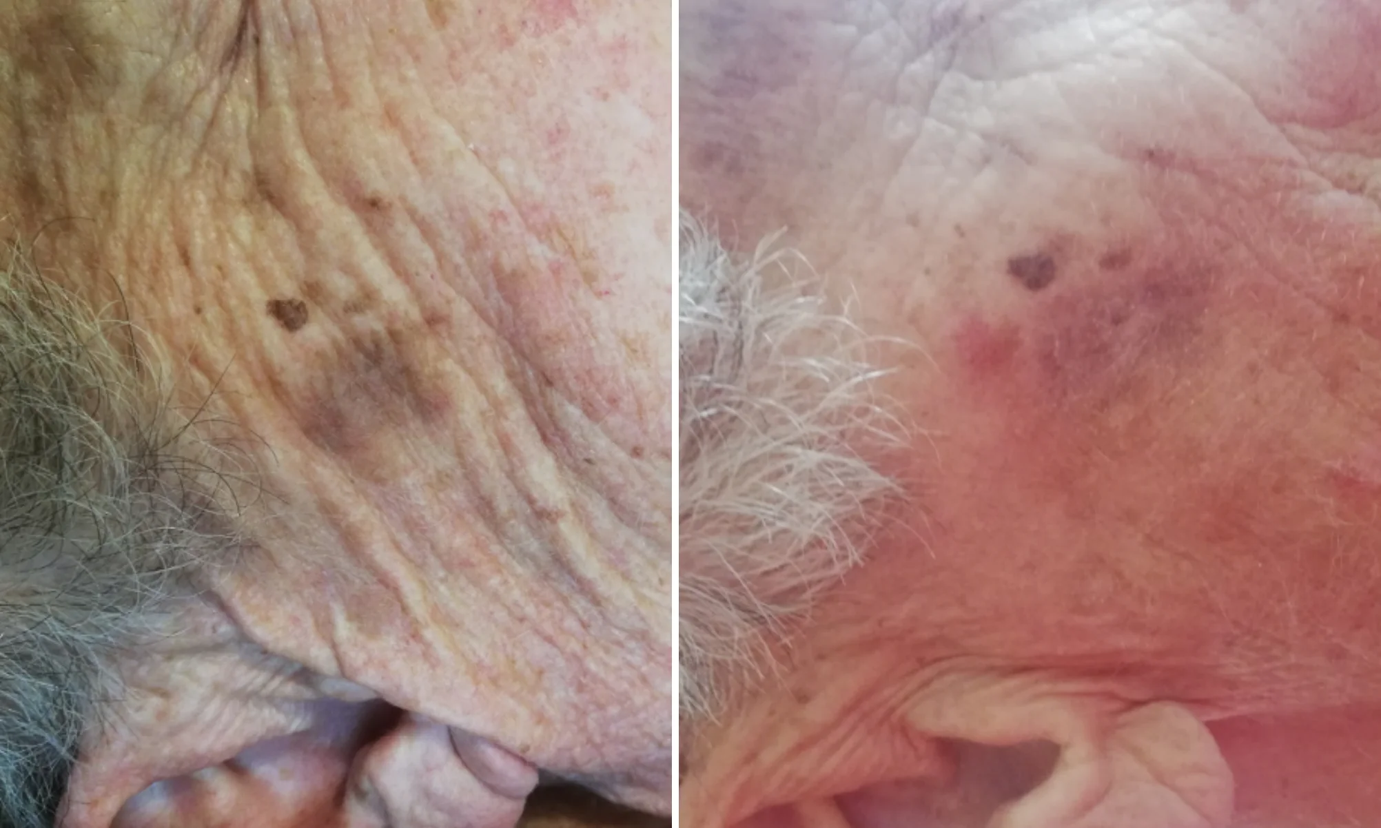 Microneedling Vancouver 10 Untitled-design-31-2.webp